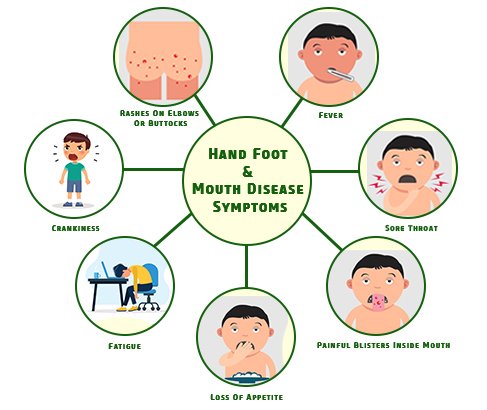 Hand Foot Mouth Disease Symptoms